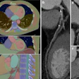 An example of machine learning–based multiorgan body composition assessment (TotalSegmentator V2.0.4, 1.5-mm high-resolution model) in a 63-year-old man with obstructive coronary artery disease and a skeletal muscle attenuation below the median. (A) Transverse, (B) coronal, and (C) sagittal CT images and curved planar reformations of the (D) left, (E) circumflex, and (F) right coronary arteries.