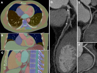 An example of machine learning–based multiorgan body composition assessment (TotalSegmentator V2.0.4, 1.5-mm high-resolution model) in a 63-year-old man with obstructive coronary artery disease and a skeletal muscle attenuation below the median. (A) Transverse, (B) coronal, and (C) sagittal CT images and curved planar reformations of the (D) left, (E) circumflex, and (F) right coronary arteries.