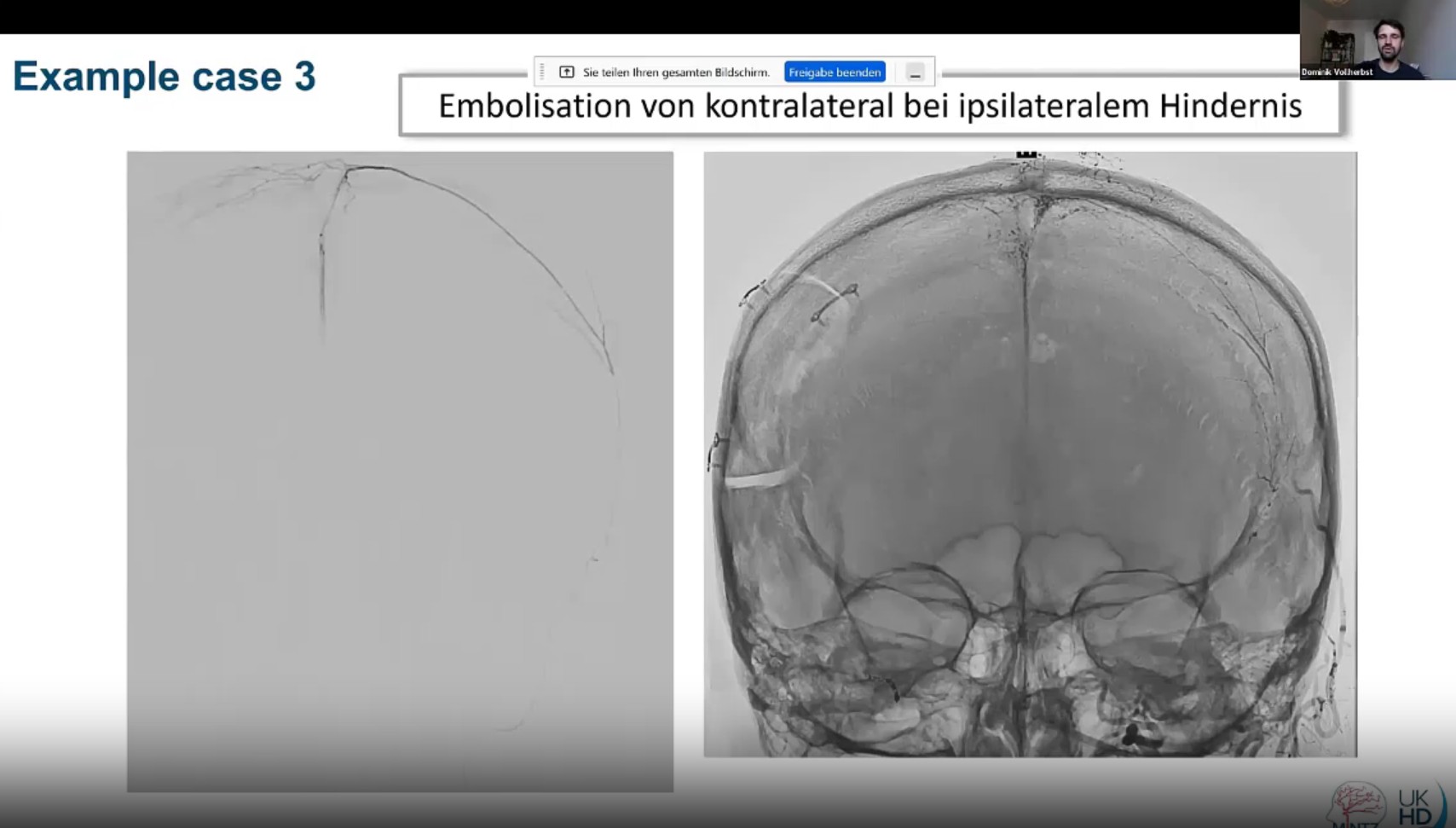 Flat-detector CT showing catheter position following contralateral middle meningeal artery embolization in a case where ipsilateral access was not possible.