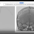 Flat-detector CT showing catheter position following contralateral middle meningeal artery embolization in a case where ipsilateral access was not possible.