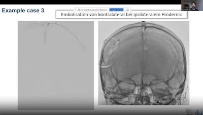 Flat-detector CT showing catheter position following contralateral middle meningeal artery embolization in a case where ipsilateral access was not possible.