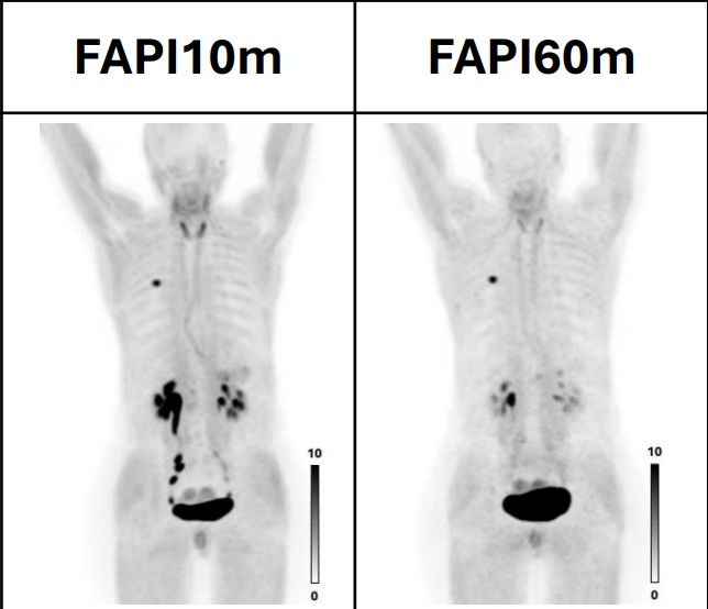 PET/CT images performed at 10- and 60-minutes following injection of Ga-68 FAPI-46 (mean 181 MBq; range 143&ndash;225 MBq).