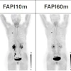 PET/CT images performed at 10- and 60-minutes following injection of Ga-68 FAPI-46 (mean 181 MBq; range 143–225 MBq).