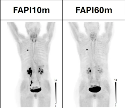 PET/CT images performed at 10- and 60-minutes following injection of Ga-68 FAPI-46 (mean 181 MBq; range 143–225 MBq).