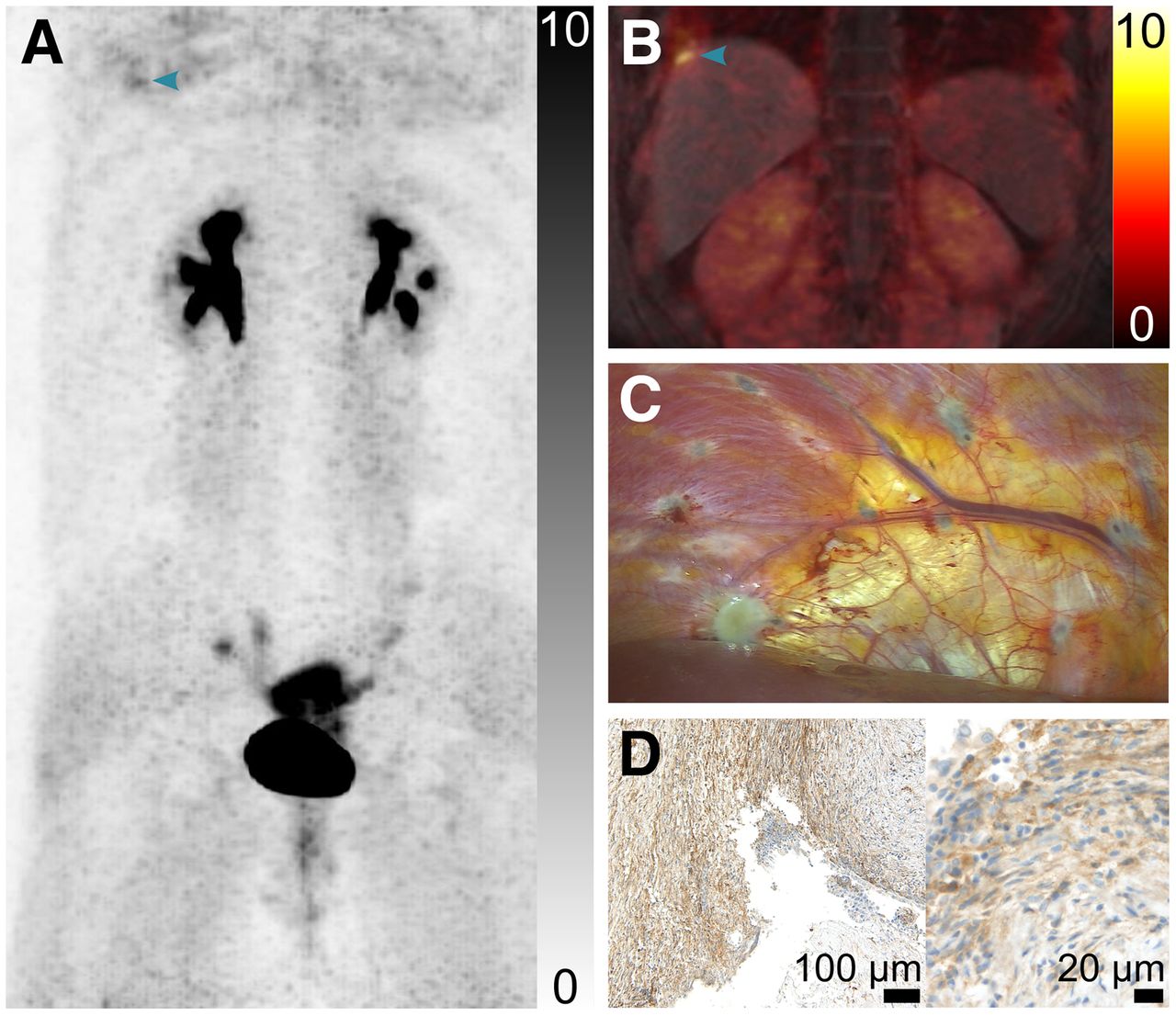 FAPI PET/MRI images from a patient with menstrual cycle-dependent right shoulder pain. PET identified diaphragmatic and pelvic lesions (A, B) later confirmed by laparoscopy (C) and FAP immunostaining (D).