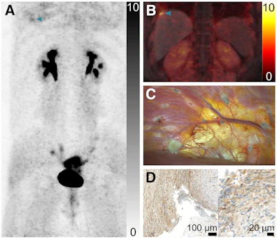 FAPI PET/MRI images from a patient with menstrual cycle-dependent right shoulder pain. PET identified diaphragmatic and pelvic lesions (A, B) later confirmed by laparoscopy (C) and FAP immunostaining (D).