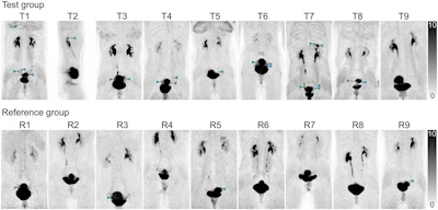 Maximum-intensity-projection PET images from the test group (T1–T9, top) and reference group (R1–R9, bottom). Blue arrowheads indicate endometriosis-suspicious findings.