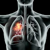 Lung Tumors