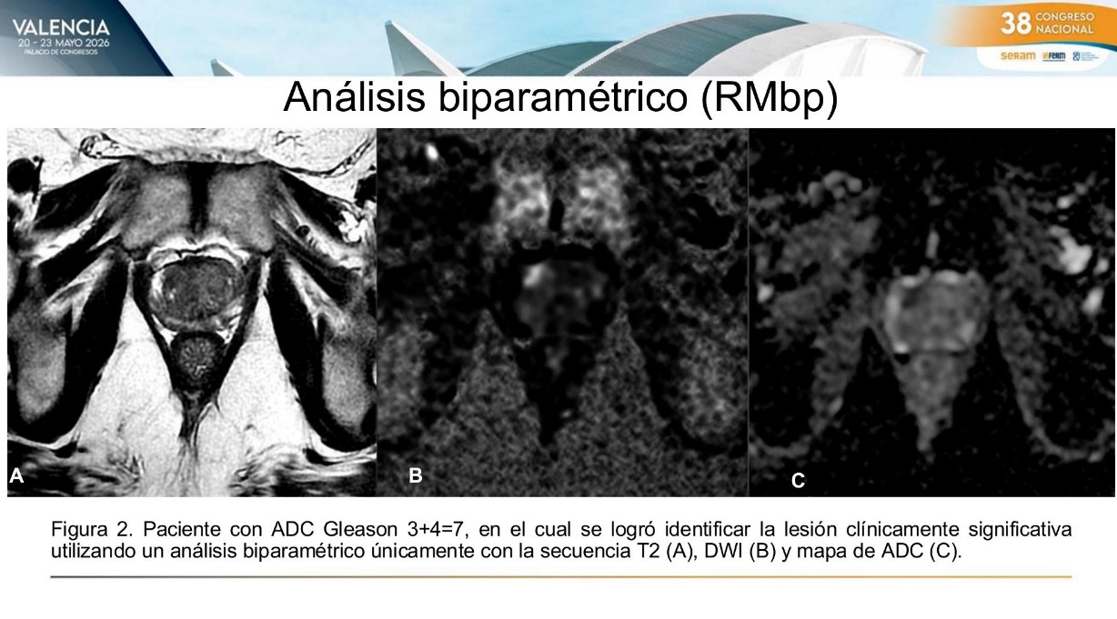Biparametric prostate MRI identified clinically significant Gleason 3+4 prostate cancer using T2-weighted imaging, diffusion-weighted imaging, and ADC mapping alone.