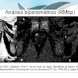 Biparametric prostate MRI identified clinically significant Gleason 3+4 prostate cancer using T2-weighted imaging, diffusion-weighted imaging, and ADC mapping alone.