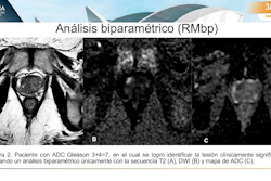 Biparametric prostate MRI identified clinically significant Gleason 3+4 prostate cancer using T2-weighted imaging, diffusion-weighted imaging, and ADC mapping alone.