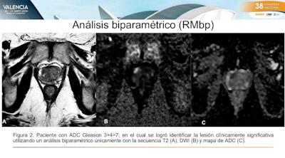 Biparametric prostate MRI identified clinically significant Gleason 3+4 prostate cancer using T2-weighted imaging, diffusion-weighted imaging, and ADC mapping alone.