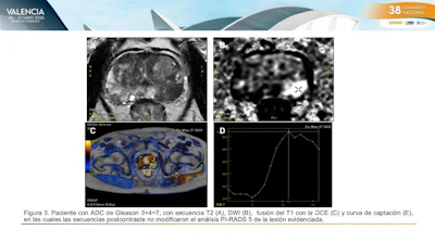 Multiparametric prostate MRI showing a PI-RADS 5 lesion in a patient with Gleason 3+4 prostate cancer. Contrast-enhanced imaging did not alter lesion assessment.