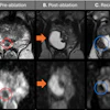 Preablation, postablation, and recurrence multiparametric MRI scans depict a 63-year-old man treated with transperineal focal laser ablation (TPLA) for localized prostate cancer. Clinical parameters included an initial prostate-specific antigen (PSA) level of 7.2 ng/mL, a Prostate Imaging Reporting and Data System (PI-RADS) grade 4 lesion (red circles) in the right apical peripheral zone, and a maximum tumor length of 5 mm. MRI-guided targeted biopsy confirmed a Gleason score 3+4 prostate cancer tumor. (A) Pre-ablation axial T2-weighted MRI scan and apparent diffusion coefficient (ADC) image shows the apical PI-RADS 4 lesion (circles). (B) Six-month post-ablation axial T2-weighted MRI scan and ADC image show cystic necrosis (arrows). There was no evidence of recurrence; the PSA level was 1.5 ng/mL. (C) One-year after ablation, the patient’s PSA level had increased to 4.3 ng/mL. Axial T2-weighted MRI scan and the ADC image shows a recurrent lesion (blue circles) in the right apical peripheral zone adjacent to the ablation scar. Targeted biopsy confirmed Gleason score 3+4 prostate cancer, which was classified as in-field recurrence of clinically significant prostate cancer and subsequently re-treated with TPLA. In summary, serial multiplanar MRI demonstrates treatment response after TPLA with post-ablation necrosis, followed by MRI-detected IFR confirmed with biopsy at 12-month follow-up. Multiparametric MRI was performed with a 3.0-T MRI scanner (Skyra; Siemens Healthineers) using T2-weighted, diffusion-weighted, and ADC sequences, with gadobenate dimeglumine contrast material administration (Bracco Diagnostics).