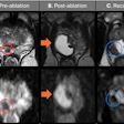 Preablation, postablation, and recurrence multiparametric MRI scans depict a 63-year-old man treated with transperineal focal laser ablation (TPLA) for localized prostate cancer. Clinical parameters included an initial prostate-specific antigen (PSA) level of 7.2 ng/mL, a Prostate Imaging Reporting and Data System (PI-RADS) grade 4 lesion (red circles) in the right apical peripheral zone, and a maximum tumor length of 5 mm. MRI-guided targeted biopsy confirmed a Gleason score 3+4 prostate cancer tumor. (A) Pre-ablation axial T2-weighted MRI scan and apparent diffusion coefficient (ADC) image shows the apical PI-RADS 4 lesion (circles). (B) Six-month post-ablation axial T2-weighted MRI scan and ADC image show cystic necrosis (arrows). There was no evidence of recurrence; the PSA level was 1.5 ng/mL. (C) One-year after ablation, the patient’s PSA level had increased to 4.3 ng/mL. Axial T2-weighted MRI scan and the ADC image shows a recurrent lesion (blue circles) in the right apical peripheral zone adjacent to the ablation scar. Targeted biopsy confirmed Gleason score 3+4 prostate cancer, which was classified as in-field recurrence of clinically significant prostate cancer and subsequently re-treated with TPLA. In summary, serial multiplanar MRI demonstrates treatment response after TPLA with post-ablation necrosis, followed by MRI-detected IFR confirmed with biopsy at 12-month follow-up. Multiparametric MRI was performed with a 3.0-T MRI scanner (Skyra; Siemens Healthineers) using T2-weighted, diffusion-weighted, and ADC sequences, with gadobenate dimeglumine contrast material administration (Bracco Diagnostics).