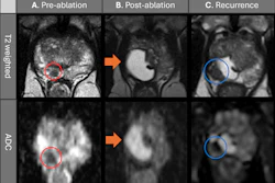 Preablation, postablation, and recurrence multiparametric MRI scans depict a 63-year-old man treated with transperineal focal laser ablation (TPLA) for localized prostate cancer. Clinical parameters included an initial prostate-specific antigen (PSA) level of 7.2 ng/mL, a Prostate Imaging Reporting and Data System (PI-RADS) grade 4 lesion (red circles) in the right apical peripheral zone, and a maximum tumor length of 5 mm. MRI-guided targeted biopsy confirmed a Gleason score 3+4 prostate cancer tumor. (A) Pre-ablation axial T2-weighted MRI scan and apparent diffusion coefficient (ADC) image shows the apical PI-RADS 4 lesion (circles). (B) Six-month post-ablation axial T2-weighted MRI scan and ADC image show cystic necrosis (arrows). There was no evidence of recurrence; the PSA level was 1.5 ng/mL. (C) One-year after ablation, the patient’s PSA level had increased to 4.3 ng/mL. Axial T2-weighted MRI scan and the ADC image shows a recurrent lesion (blue circles) in the right apical peripheral zone adjacent to the ablation scar. Targeted biopsy confirmed Gleason score 3+4 prostate cancer, which was classified as in-field recurrence of clinically significant prostate cancer and subsequently re-treated with TPLA. In summary, serial multiplanar MRI demonstrates treatment response after TPLA with post-ablation necrosis, followed by MRI-detected IFR confirmed with biopsy at 12-month follow-up. Multiparametric MRI was performed with a 3.0-T MRI scanner (Skyra; Siemens Healthineers) using T2-weighted, diffusion-weighted, and ADC sequences, with gadobenate dimeglumine contrast material administration (Bracco Diagnostics).
