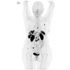 Maximum intensity projections showing biodistribution of Cu-61 NODAGA-LM3 (146 MBq) in a patient with a metastatic non-functional NET of the pancreas G2 (Ki-67: 5%) with lymph node, hepatic, osseous, and peritoneal as well as ovarian metastases. PET performed a 1-hour, 3-hours, and 18-hours post-injection show high and prolonged tumor uptake and excellent image contrast, with low uptake in the liver, intestinal tract, and other non-target organs.