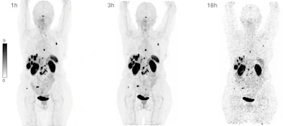Maximum intensity projections showing biodistribution of Cu-61 NODAGA-LM3 (146 MBq) in a patient with a metastatic non-functional NET of the pancreas G2 (Ki-67: 5%) with lymph node, hepatic, osseous, and peritoneal as well as ovarian metastases. PET performed a 1-hour, 3-hours, and 18-hours post-injection show high and prolonged tumor uptake and excellent image contrast, with low uptake in the liver, intestinal tract, and other non-target organs.