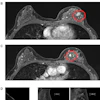 MRI false positive for additional disease, (top to bottom): A. Index lesion—grade 2 invasive ductal carcinoma; B. MRI lesion two, upper inner quadrant: Stromal sclerosis and columnar cell change; C. MRI lesion three, upper outer quadrant: No ultrasound correlate, no malignancy on follow-up; D. CEM marked background parenchymal enhancement with a unifocal retroareolar lesion demonstrating wash-out on delayed MLO. Images are republished under a Creative Commons license (CC BY 4.0).