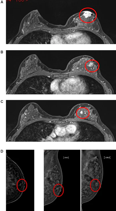MRI false positive for additional disease, (top to bottom): A. Index lesion—grade 2 invasive ductal carcinoma; B. MRI lesion two, upper inner quadrant: Stromal sclerosis and columnar cell change; C. MRI lesion three, upper outer quadrant: No ultrasound correlate, no malignancy on follow-up; D. CEM marked background parenchymal enhancement with a unifocal retroareolar lesion demonstrating wash-out on delayed MLO. Images are republished under a Creative Commons license (CC BY 4.0).