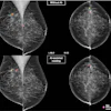 Mammography comparison showing breast cancer screening with and without AI-assisted detection markers