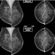 Mammography comparison showing breast cancer screening with and without AI-assisted detection markers