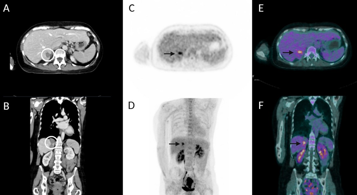 Three months after thermal ablation, contrast-enhanced CT (A, B) shows post-treatment changes without clear local progression, while FDG-PET/CECT (C&ndash;F) reveals focal uptake suspicious for recurrence.