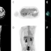 Three months after thermal ablation, contrast-enhanced CT (A, B) shows post-treatment changes without clear local progression, while FDG-PET/CECT (C–F) reveals focal uptake suspicious for recurrence.