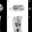 Three months after thermal ablation, contrast-enhanced CT (A, B) shows post-treatment changes without clear local progression, while FDG-PET/CECT (C–F) reveals focal uptake suspicious for recurrence.