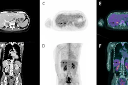 Three months after thermal ablation, contrast-enhanced CT (A, B) shows post-treatment changes without clear local progression, while FDG-PET/CECT (C–F) reveals focal uptake suspicious for recurrence.
