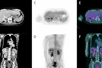 Three months after thermal ablation, contrast-enhanced CT (A, B) shows post-treatment changes without clear local progression, while FDG-PET/CECT (C–F) reveals focal uptake suspicious for recurrence.