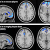 Voxel-based morphometry (VBM) group comparison of grey matter brain volumes. TFCE-corrected significance map shown (one-tailed t-test; higher significance indicated by light blue color). (a) Comparison between ex-soccer players (n = 124) and controls (n = 40). (b) Comparison between ex-rugby players (n = 200) and controls (n = 33) from Graham & Zimmerman et al. (2025), reproduced with permission under Creative Commons license.