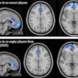Voxel-based morphometry (VBM) group comparison of grey matter brain volumes. TFCE-corrected significance map shown (one-tailed t-test; higher significance indicated by light blue color). (a) Comparison between ex-soccer players (n = 124) and controls (n = 40). (b) Comparison between ex-rugby players (n = 200) and controls (n = 33) from Graham & Zimmerman et al. (2025), reproduced with permission under Creative Commons license.