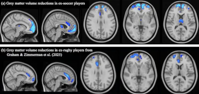 Voxel-based morphometry (VBM) group comparison of grey matter brain volumes. TFCE-corrected significance map shown (one-tailed t-test; higher significance indicated by light blue color). (a) Comparison between ex-soccer players (n = 124) and controls (n = 40). (b) Comparison between ex-rugby players (n = 200) and controls (n = 33) from Graham & Zimmerman et al. (2025), reproduced with permission under Creative Commons license.