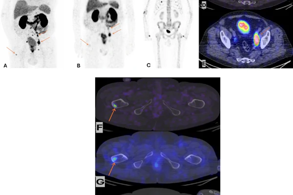 Maximum intensity projection of Ga-68 PSMA-11 PET/CE-CT (A), Tc-99m MIP-1404 CZT SPECT/CT (B) and Tc-99m HDP CZT SPECT/CT (C) imaging. Ga-68 PSMA-11 PET/CE-CT and Tc-99m MIP-1404 CZT SPECT/CT showing tracer uptake in lymph nodes below the iliac bifurcation and above, paraaortic and left supraclavicular, bone uptake in the right proximal femur and right scapula (arrows). Tc-99m HDP CZT SPECT/CT did not show any uptake suspicious for metastatic disease. No sclerotic lesions suspicious of metastases were detected by the CT component in any of the studies. Fusion axial imaging of Ga-68 PSMA-11 PET/CE-CT (D) and Tc-99m MIP-1404 CZT SPECT/CT (E) showing uptake in lymph nodes in the left pelvic area below the iliac bifurcation (arrows). Fusion axial imaging of Ga-68 PSMA-11 PET/CE-CT (F) and Tc-99m MIP-1404 CZT SPECT/CT (G) showing uptake in the right proximal femur, not detected by Tc-99m HDP CZT SPECT/CT (H), (arrows).