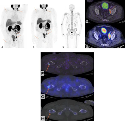 Maximum intensity projection of Ga-68 PSMA-11 PET/CE-CT (A), Tc-99m MIP-1404 CZT SPECT/CT (B) and Tc-99m HDP CZT SPECT/CT (C) imaging. Ga-68 PSMA-11 PET/CE-CT and Tc-99m MIP-1404 CZT SPECT/CT showing tracer uptake in lymph nodes below the iliac bifurcation and above, paraaortic and left supraclavicular, bone uptake in the right proximal femur and right scapula (arrows). Tc-99m HDP CZT SPECT/CT did not show any uptake suspicious for metastatic disease. No sclerotic lesions suspicious of metastases were detected by the CT component in any of the studies. Fusion axial imaging of Ga-68 PSMA-11 PET/CE-CT (D) and Tc-99m MIP-1404 CZT SPECT/CT (E) showing uptake in lymph nodes in the left pelvic area below the iliac bifurcation (arrows). Fusion axial imaging of Ga-68 PSMA-11 PET/CE-CT (F) and Tc-99m MIP-1404 CZT SPECT/CT (G) showing uptake in the right proximal femur, not detected by Tc-99m HDP CZT SPECT/CT (H), (arrows).