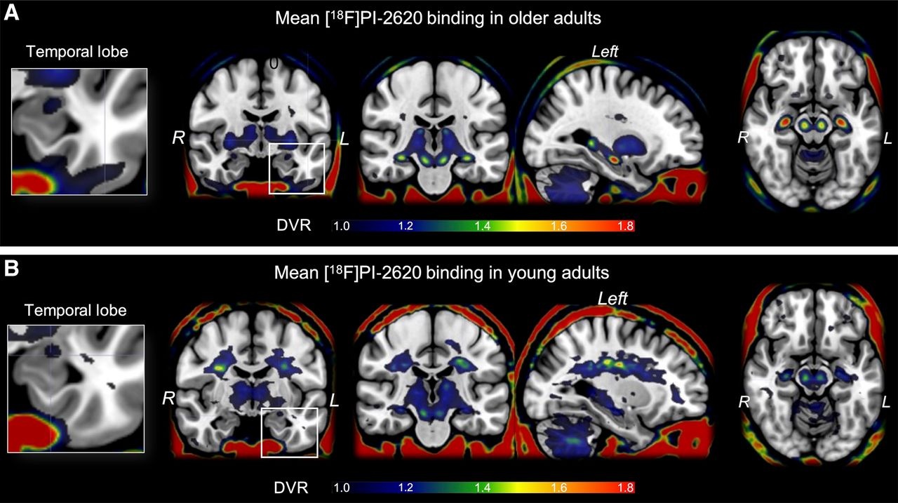F-18 PI-2620 average binding potential maps. Mean tracer binding (DVR) image from 165 older adults (A) and 13 young adults (B). Images are scaled from 1 to 1.8 for display purposes, but DVR values of less than 1 were frequently observed.