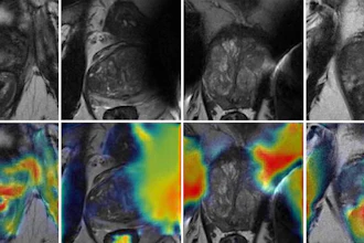 Low-quality axial T2-weighted MRI scans with gradient-weighted class activation mapping. The low-quality MRI scans (top row) show blurred structures and artifacts making zonal and capsule boundaries indistinguishable. On the same scans with gradient-weighted class activation map overlays (bottom row), red indicates regions that were most heavily weighted by the deep learning model toward the low-quality prediction.