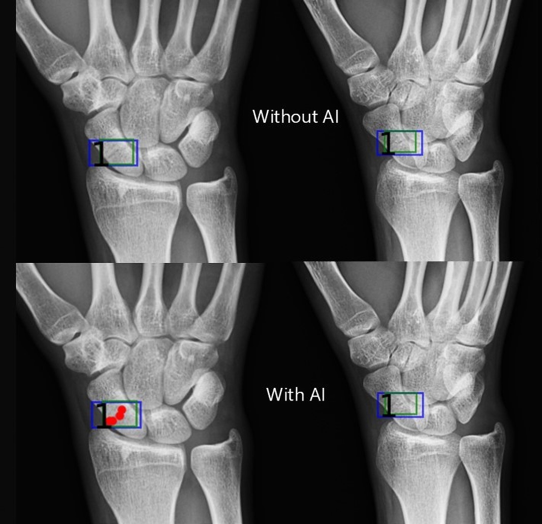 Artificial intelligence (AI) assistance facilitates correct fracture identification in cases initially missed by human readers. A representative case is shown using anteroposterior radiographs in a 29-year-old male patient with wrist trauma (suspected nondisplaced transverse scaphoid fracture). The reader’s initial unaided assessment (top) resulted in a missed fracture, whereas with AI assistance (bottom), the fracture was correctly identified. The green box represents the fracture location as predicted by the AI tool, the blue box represents the reference standard annotation, and the red dots represent individual reader annotations.