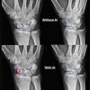 Artificial intelligence (AI) assistance facilitates correct fracture identification in cases initially missed by human readers. A representative case is shown using anteroposterior radiographs in a 29-year-old male patient with wrist trauma (suspected nondisplaced transverse scaphoid fracture). The reader’s initial unaided assessment (top) resulted in a missed fracture, whereas with AI assistance (bottom), the fracture was correctly identified. The green box represents the fracture location as predicted by the AI tool, the blue box represents the reference standard annotation, and the red dots represent individual reader annotations.