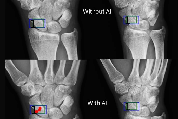 Artificial intelligence (AI) assistance facilitates correct fracture identification in cases initially missed by human readers. A representative case is shown using anteroposterior radiographs in a 29-year-old male patient with wrist trauma (suspected nondisplaced transverse scaphoid fracture). The reader’s initial unaided assessment (top) resulted in a missed fracture, whereas with AI assistance (bottom), the fracture was correctly identified. The green box represents the fracture location as predicted by the AI tool, the blue box represents the reference standard annotation, and the red dots represent individual reader annotations.