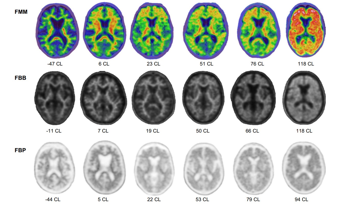 Representative amyloid PET images acquired with flutemetamol, florbetaben, and florbetapir across a range of Centiloid values.