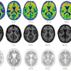 Representative amyloid PET images acquired with flutemetamol, florbetaben, and florbetapir across a range of Centiloid values.