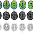 Representative amyloid PET images acquired with flutemetamol, florbetaben, and florbetapir across a range of Centiloid values.