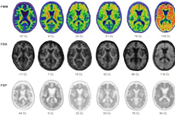 Representative amyloid PET images acquired with flutemetamol, florbetaben, and florbetapir across a range of Centiloid values.