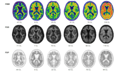 Representative amyloid PET images acquired with flutemetamol, florbetaben, and florbetapir across a range of Centiloid values.