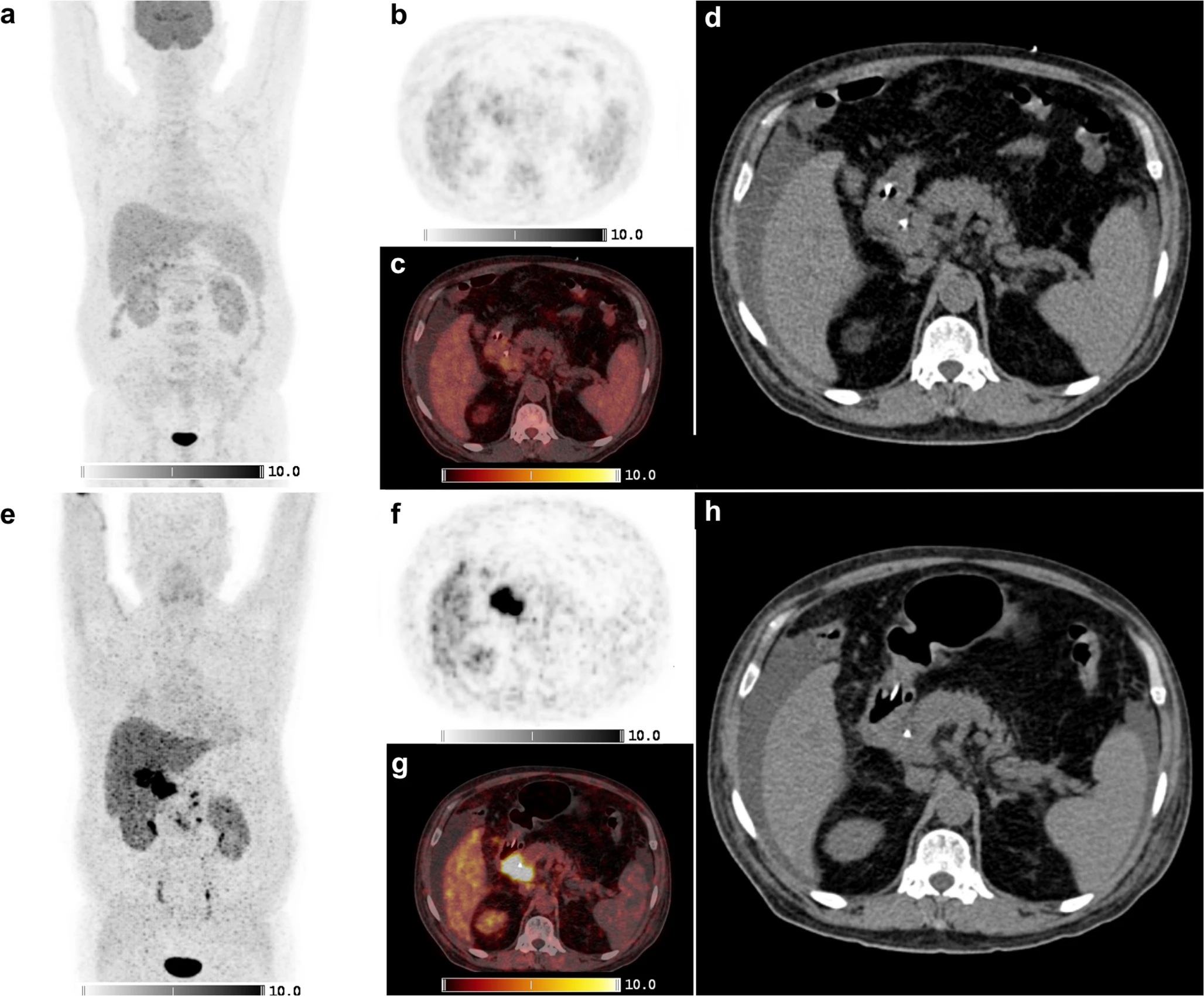Shown is a 69-year-old man with a cholangiocarcinoma in the distal common bile duct. F-18 FDG-PET/CT was negative where Ga-68 FAPI-46 PET/CT showed high focal FAPI uptake in the liver hilum and surrounding lymph nodes. a-d: F-18 FDG-PET/CT, e-h: Ga-68 FAPI-46 PET/CT. a, b, e, f: Maximum intensity projections, c, g: axial fusion images, d, h: non-contrast enhanced CT.
