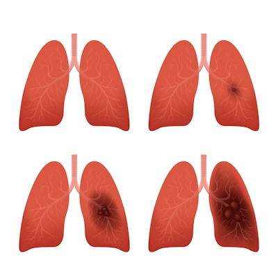 Lung Cancer Stages 400