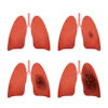 Lung Cancer Stages 400
