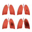 Lung Cancer Stages 400